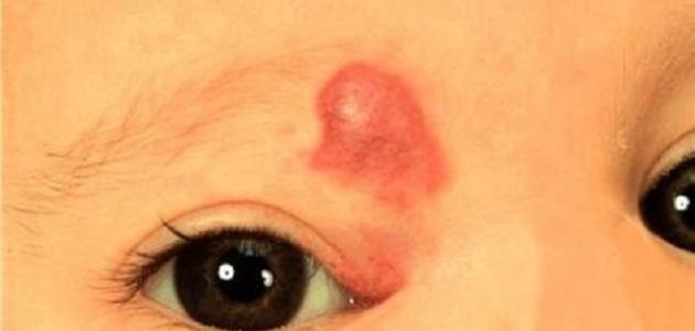 سبب ظهور بقع حمراء في الوجه صورة مقال سبب ظهور بقع حمراء في الوجه