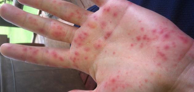 سبب ظهور حبوب تحت الجلد صورة مقال سبب ظهور حبوب تحت الجلد