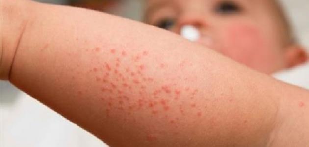 سبب ظهور حبوب حمراء عند الأطفال صورة مقال سبب ظهور حبوب حمراء عند الأطفال