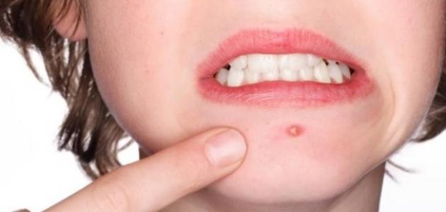 سبب ظهور الدمامل في الوجه صورة مقال سبب ظهور الدمامل في الوجه