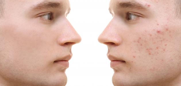 طرق إزالة الحبوب الدهنية من الوجه صورة مقال طرق إزالة الحبوب الدهنية من الوجه