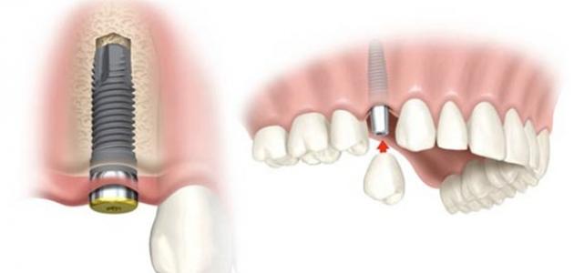 زراعة الأسنان وفوائدها - فيديو صورة مقال زراعة الأسنان وفوائدها - فيديو