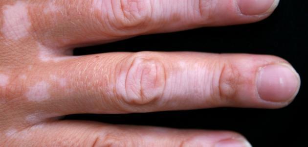 فوائد القطران للبهاق صورة مقال فوائد القطران للبهاق