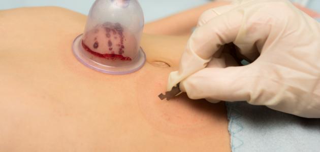 ما هي الحجامة وأنواعها صورة مقال ما هي الحجامة وأنواعها