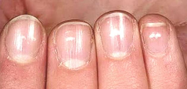 سبب ظهور بقع بنية على الأظافر صورة مقال سبب ظهور بقع بنية على الأظافر