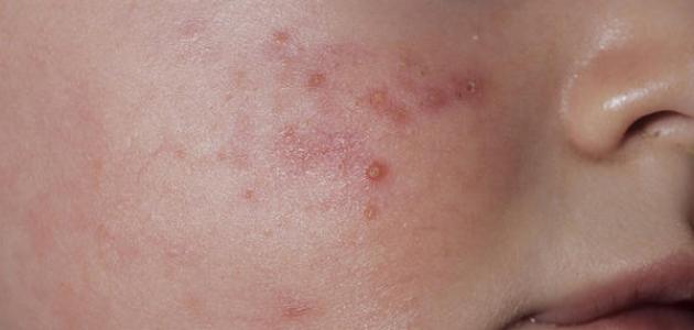 ظهور الحبوب على وجه الرضيع صورة مقال ظهور الحبوب على وجه الرضيع