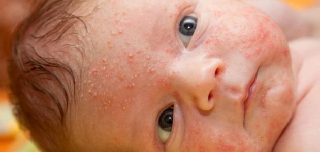 ظهور حبوب في وجه المولود صورة مقال ظهور حبوب في وجه المولود