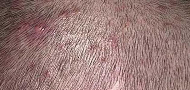 ظهور حبة في فروة الرأس صورة مقال ظهور حبة في فروة الرأس
