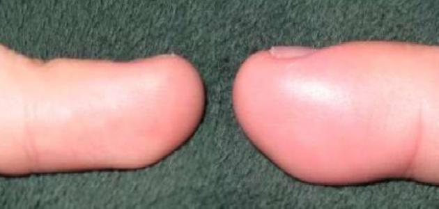 ظهور تورمات في الجسم صورة مقال ظهور تورمات في الجسم