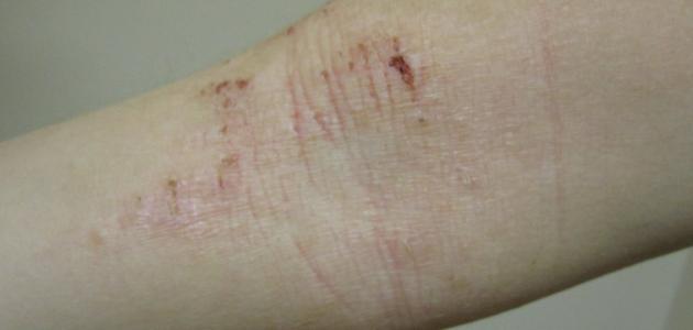 ظهور قشور على الجلد صورة مقال ظهور قشور على الجلد