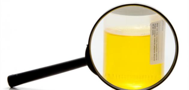 ما هي أعراض التهاب البول صورة مقال ما هي أعراض التهاب البول