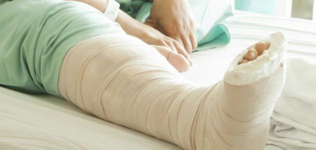 ما هو علاج كسور العظام ومضاعفاته - فيديو صورة مقال ما هو علاج كسور العظام ومضاعفاته - فيديو