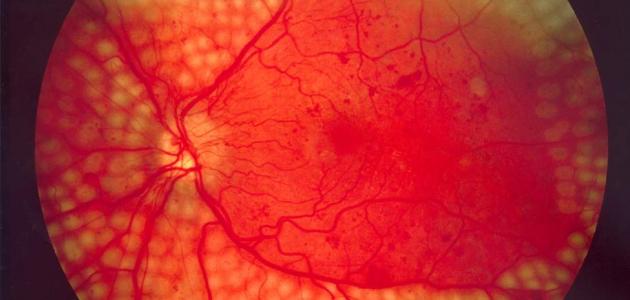 اعتلال الشبكية الوعائي صورة مقال اعتلال الشبكية الوعائي