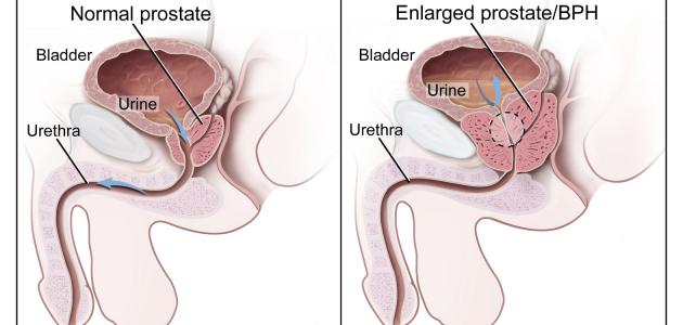 ما هو سبب مرض البروستات صورة مقال ما هو سبب مرض البروستات