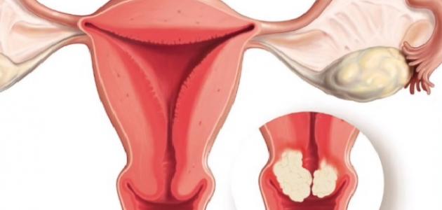 ما هو سرطان عنق الرحم صورة مقال ما هو سرطان عنق الرحم