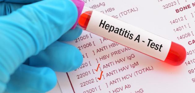 أعراض الكبد الوبائي أ صورة مقال أعراض الكبد الوبائي أ
