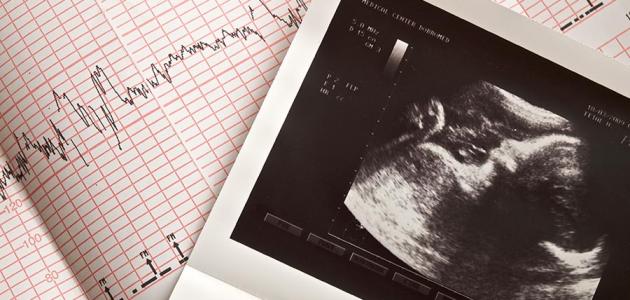 الموجات فوق الصوتية للتأكد من الحمل صورة مقال الموجات فوق الصوتية للتأكد من الحمل
