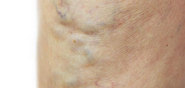 دوالي الساقين والحمل صورة مقال دوالي الساقين والحمل