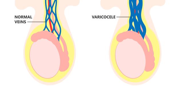كيفية تشخيص دوالي الخصيتين صورة مقال كيفية تشخيص دوالي الخصيتين
