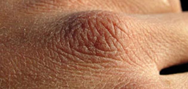 كيفية ترطيب البشرة الجافة صورة مقال كيفية ترطيب البشرة الجافة