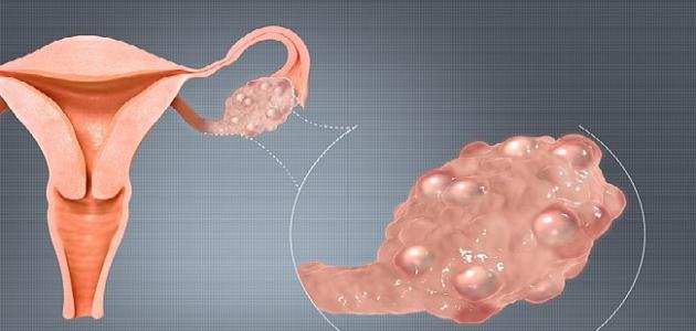 السمنة ومتلازمة تكيس المبايض صورة مقال السمنة ومتلازمة تكيس المبايض