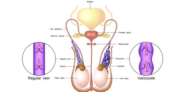 ما أسباب دوالي الخصية صورة مقال ما أسباب دوالي الخصية