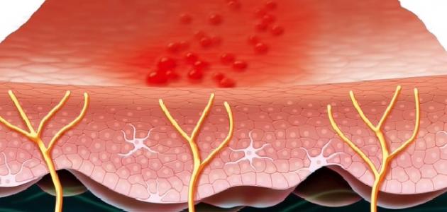 ما هي أسباب مرض الحزام الناري صورة مقال ما هي أسباب مرض الحزام الناري