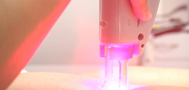 متى يتساقط الشعر بعد الليزر صورة مقال متى يتساقط الشعر بعد الليزر