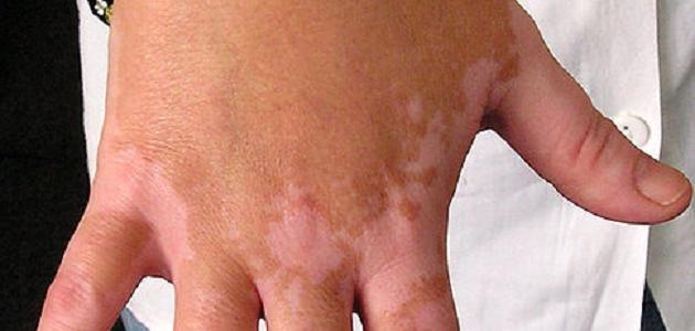 البقع الجلدية صورة مقال البقع الجلدية