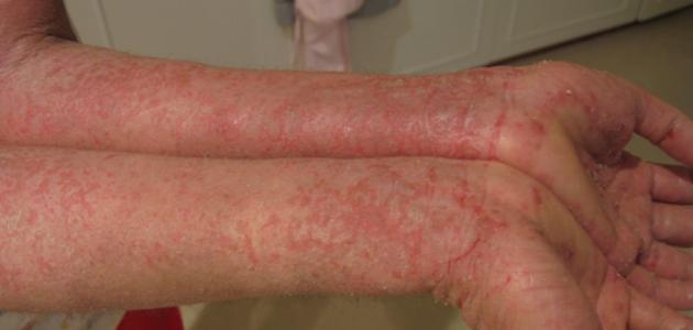 أسباب الإكزيما صورة مقال أسباب الإكزيما