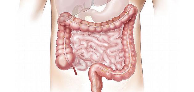 التهاب الأمعاء صورة مقال التهاب الأمعاء