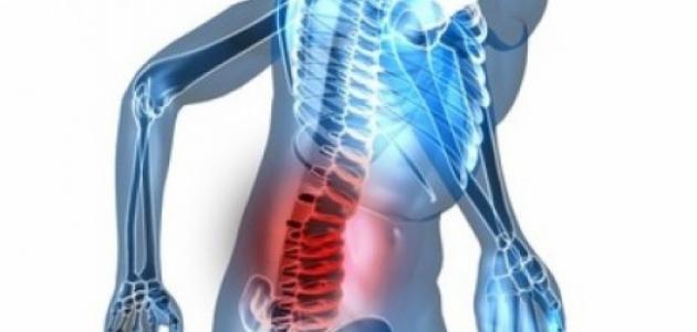 كيفية علاج انزلاق الفقرات صورة مقال كيفية علاج انزلاق الفقرات
