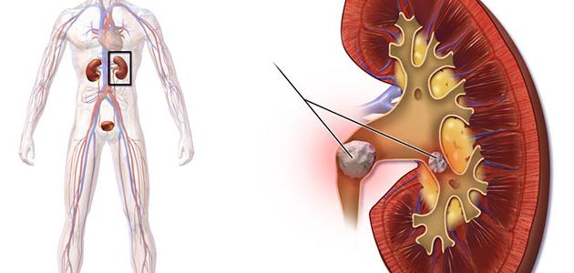 تضخم الكلى صورة مقال تضخم الكلى