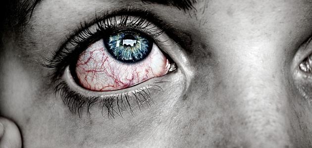 التهاب العين صورة مقال التهاب العين