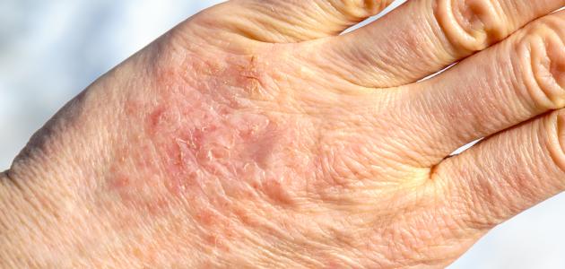 أسباب تجعد اليدين صورة مقال أسباب تجعد اليدين