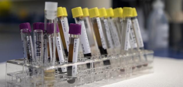 تحليل النقرس صورة مقال تحليل النقرس