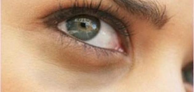 أسباب سواد تحت العين صورة مقال أسباب سواد تحت العين