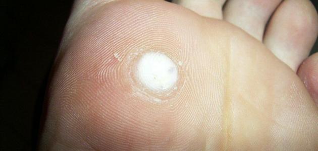 أفضل علاج للثؤلول صورة مقال أفضل علاج للثؤلول