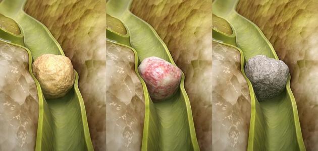 حصى في مجرى الكبد صورة مقال حصى في مجرى الكبد