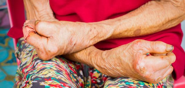 أعراض مرض الجذام صورة مقال أعراض مرض الجذام