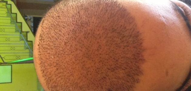 ما بعد زراعة الشعر صورة مقال ما بعد زراعة الشعر