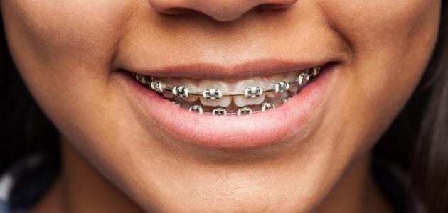 كيفية إزالة تقويم الأسنان صورة مقال كيفية إزالة تقويم الأسنان