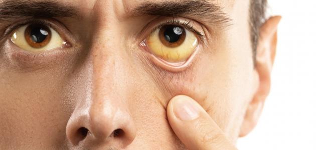 أعراض ارتفاع هيموجلوبين الدم صورة مقال أعراض ارتفاع هيموجلوبين الدم