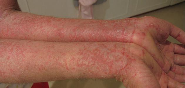 التهاب جلدي صورة مقال التهاب جلدي