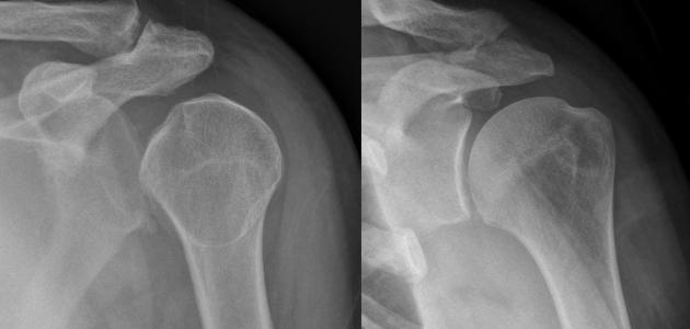 آثار خلع الكتف صورة مقال آثار خلع الكتف