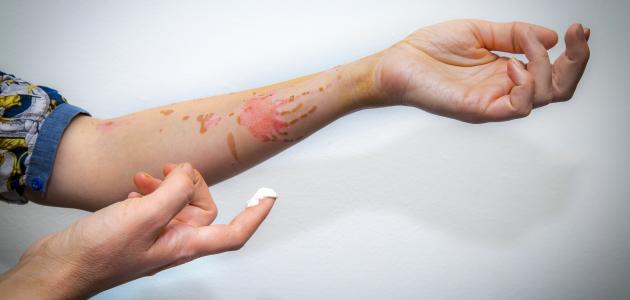 علاج حروق الزيت صورة مقال علاج حروق الزيت