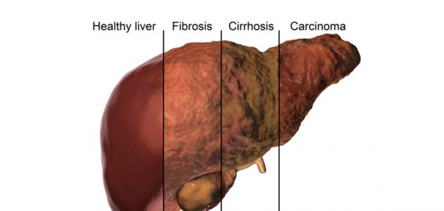 الفرق بين تشمع الكبد وتليف الكبد صورة مقال الفرق بين تشمع الكبد وتليف الكبد