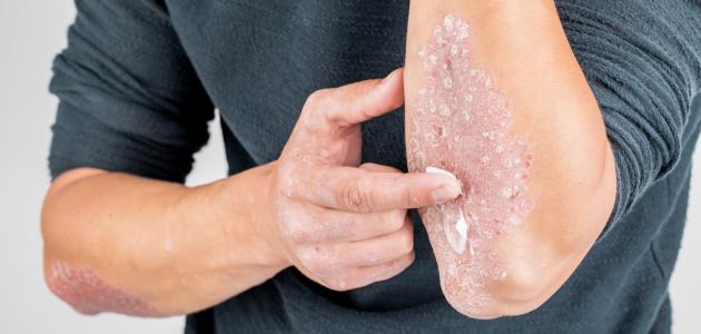 التهاب الجلد التحسسي صورة مقال التهاب الجلد التحسسي