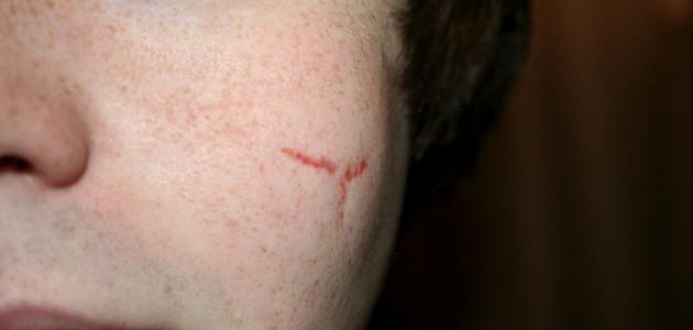 طريقة إزالة الندوب من الوجه صورة مقال طريقة إزالة الندوب من الوجه