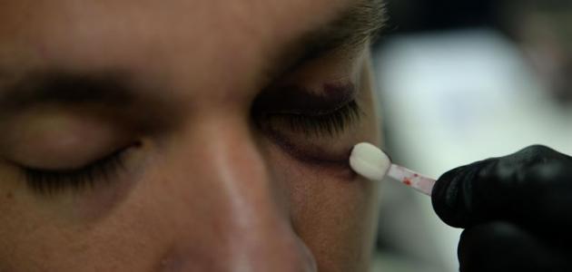 طريقة إزالة آثار الكدمات من الوجه صورة مقال طريقة إزالة آثار الكدمات من الوجه